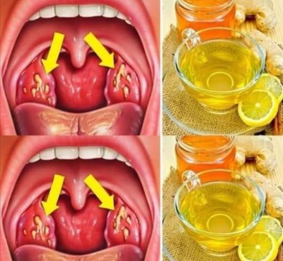 How to Cure Tonsillitis Fast and Naturally
