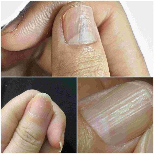 Recipe: The Real Causes of Vertical Ridges on Your Nails