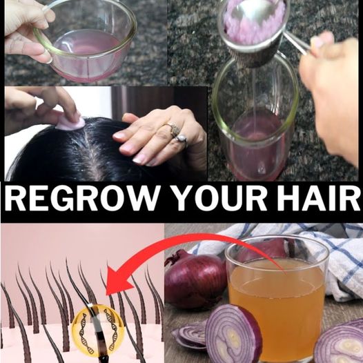 Onion Juice for Hair Care: Regrowth, Dandruff Control, Hair Fall Reduction, and Premature Greying Prevention