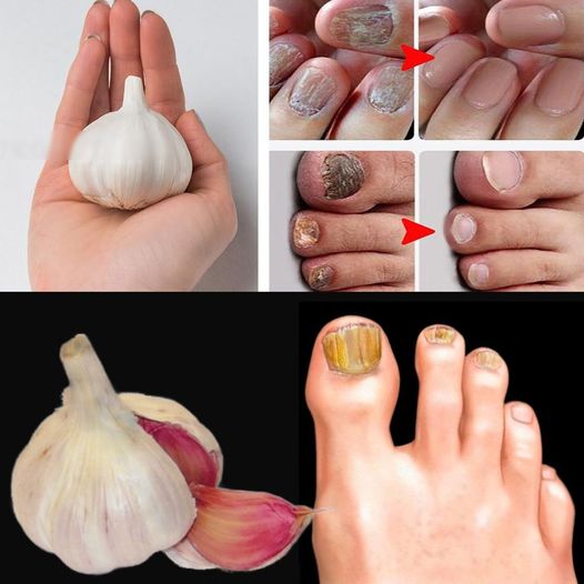 Natural Remedy Recipe for Instantly Removing Nail Fungus