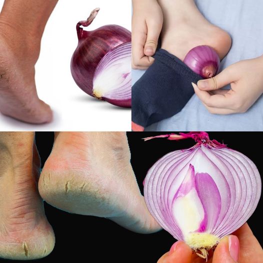Magical Home Remedy for Cracked Heels: Get Beautiful Feet Forever
