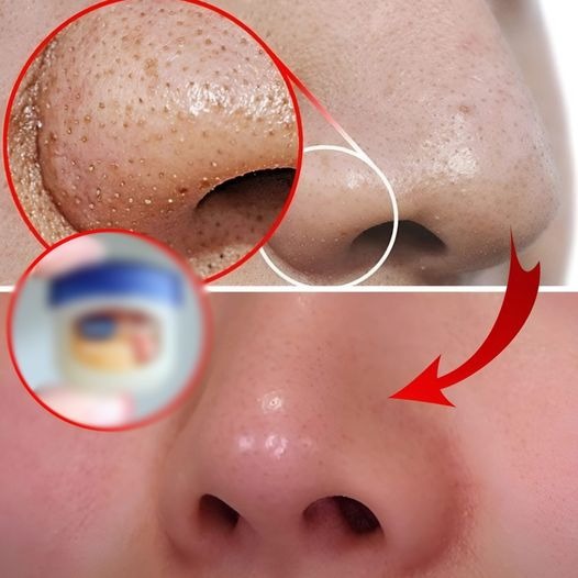 Recipe: Remove Blackheads on Your Nose with Vaseline and Baking Soda