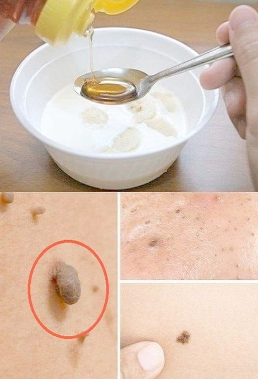 Natural Remedy for Warts, Blackheads, and Age Spots