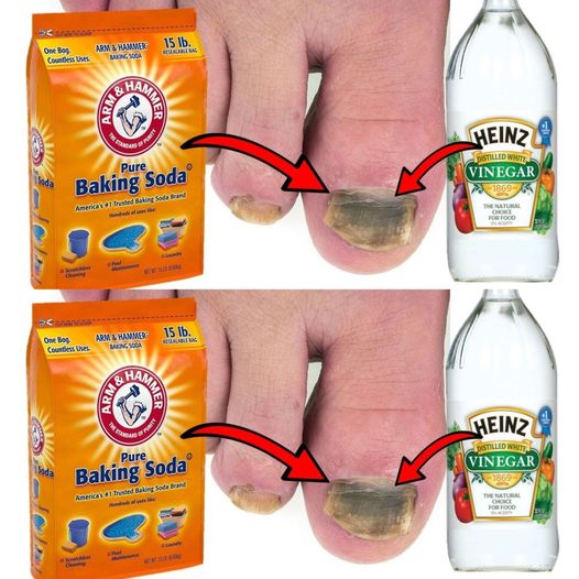 Natural Nail Fungus Treatment Recipe