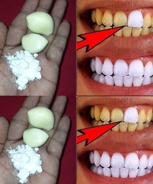 Why Garlic is most important for teeth whitening?