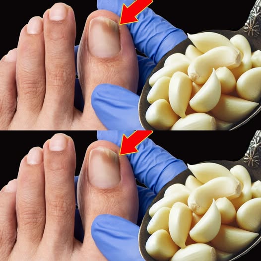 Nail Fungus Killer: The Fast-Acting Solution You’ve Been Waiting For