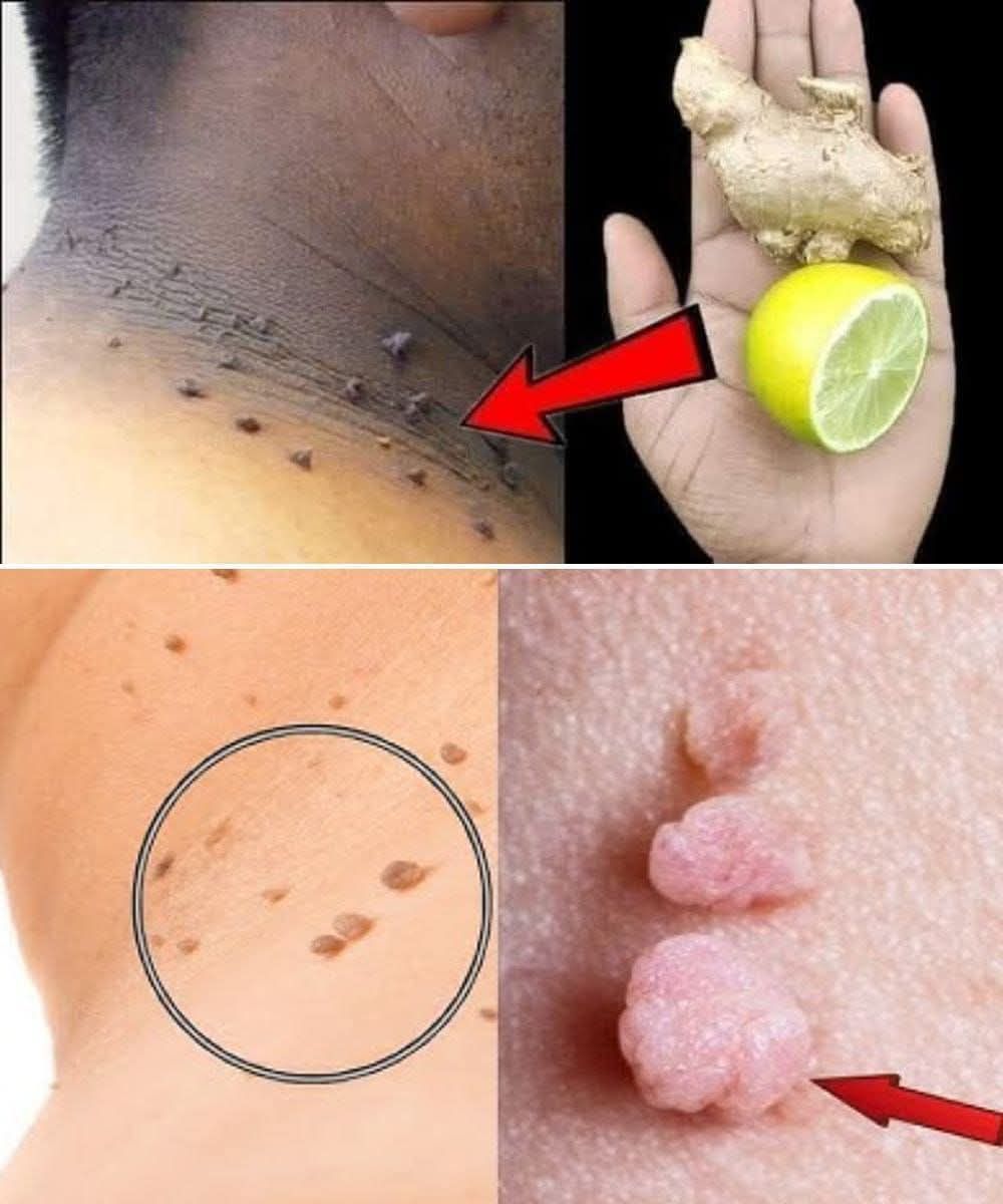 Fast and Easy Natural Skin Tag Removal Recipe