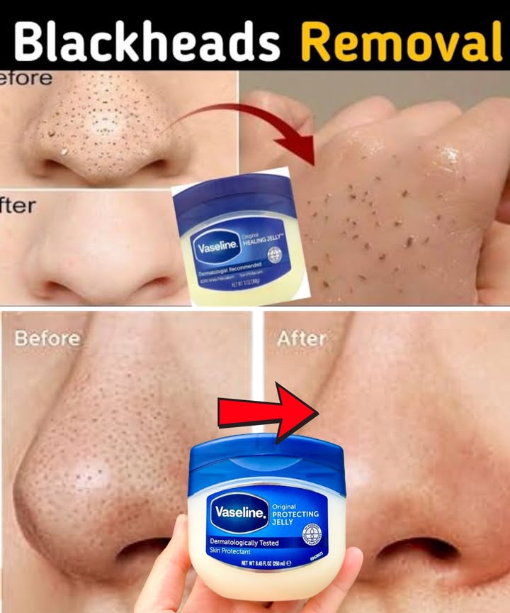 How to Remove Blackheads and Whiteheads from Your Nose & Face Naturally at Home Using Vaseline