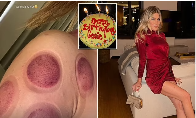 Tennis Glamour Girl Eugenie Bouchard Reveals the Brutal Results of Cupping Treatment